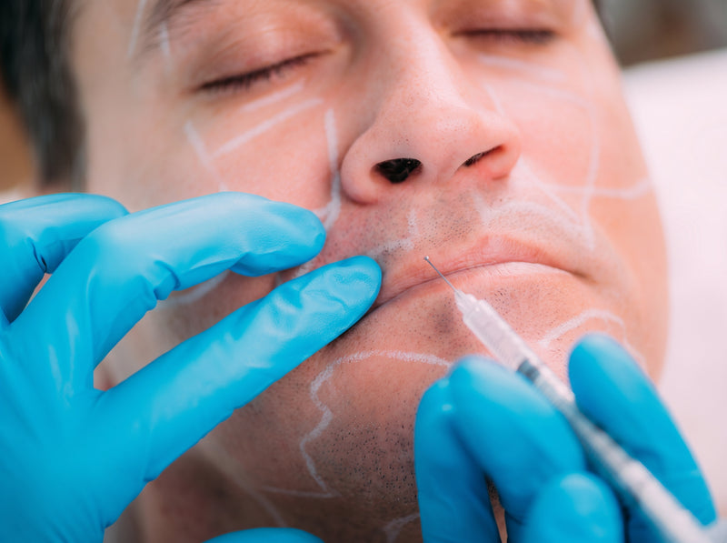 A man receiving a filler injection along marked lines on his face